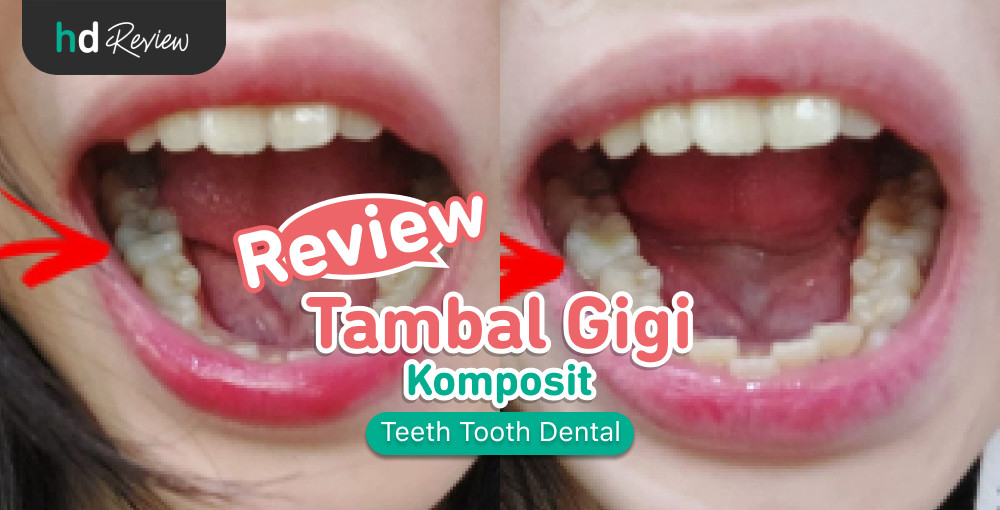 Review Tambal Gigi Di Teeth Tooth Dental HDmall