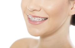 Pasang Behel Metal di Kingdom Dental Care