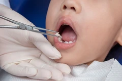 Cabut Gigi di Schon dental