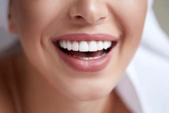 Indirect Veneer Porcelain/E-max di Klinik Gigi Dewi