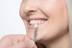 Direct Veneer Komposit dengan LED di My n Your Dentist