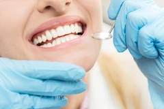 Direct Veneer Komposit di Tidi Dental Clinic