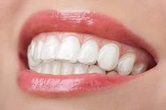 Retainer Permanen di Klinik Gigi Dewi