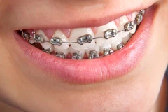 Pasang Behel Metal oleh drg. Spesialis Ortodontik + Scaling Gigi di Denta Beauty