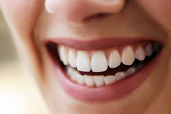 Indirect Veneer Porcelain di Schon Dental
