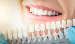 Instant Direct Veneer Komposit di Schon Dental