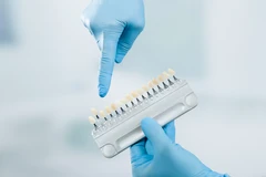Indirect Veneer Keramik E-max di Cheerful Dental Clinic