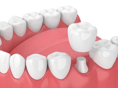 Crown Porcelain Fused to Metal (PFM) di Cheerful Dental Clinic