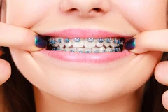 Pasang Behel Metal oleh drg. Spesialis Ortodontik di Alea Dental