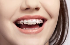 Pasang Behel Keramik oleh drg. Spesialis Ortodontik di Alea Dental