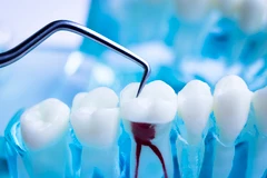 Paket perawatan saluran akar - gigi depan (akar tunggal) + Penambalan composite di Ananta Dental