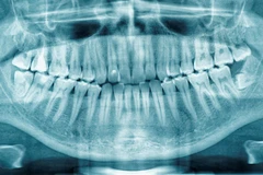Rontgen Panoramic di BSD Dental Centre