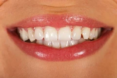 Direct Veneer Komposit di dentist & dentists