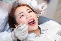 Cabut Gigi Susu Kasus Ringan + Scaling Gigi di Get Dentist