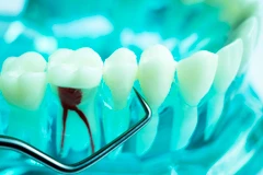 Perawatan saluran akar gigi (per akar) 1x di PI Dental Care
