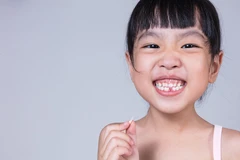 Cabut Gigi Susu di Empire Dental Studio
