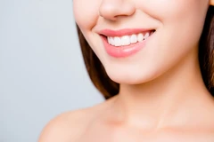 Direct Veneer Komposit 8 Gigi di Natura Dentica Dental Studio