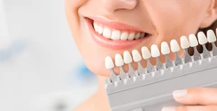 Direct Veneer Komposit di Praktik drg. Putri Linda Sari