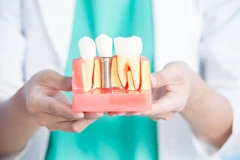 Implan Gigi di dentist & dentists