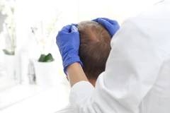 Anti-Hair Loss Therapy di Genese Clinic