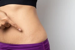 Perawatan INDIBA: Triple Proionic Anti-Stretch Mark di Genese Clinic