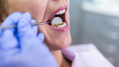 Scaling Gigi + Stain Removal di Host Dental Care