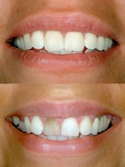 Direct Veneer Komposit di Pondok Gigi