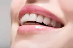 Bleaching Gigi dengan LED di My Dental Studio