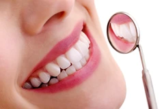 Direct Veneer Komposit 16 Gigi di Griya Denta Clinic