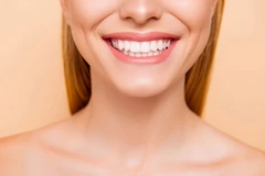 Direct Veneer Komposit di Dentaline dental care