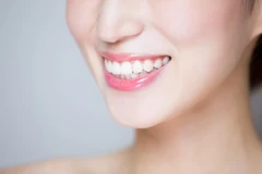 Direct Veneer Komposit di Tooth's Kingdom Dental Care