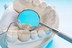 Tambal Gigi di Schon Dental