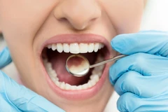 Tambal Estetika Gigi Depan Komposit di Ananta Dental
