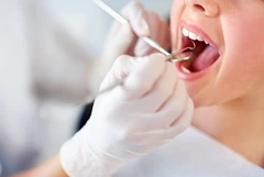 Scaling Gigi + Polishing + Fluoride Coating + Pemeriksaan Gigi dan Mulut di A+ Dental Care