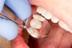 Scaling Gigi + Stain Removal + Polishing + Pemeriksaan Gigi dengan Kamera Intraoral di Green Dental Karawaci