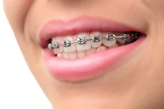 Pasang Behel Damon Metal di Embun Galaxi Dental Care