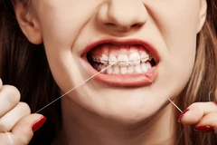 Pasang Behel Sapphire oleh drg. Umum di Embun Galaxi Dental Care