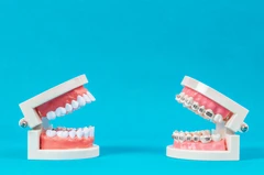 Pasang Behel Sapphire oleh drg. Umum di AM Dental Care