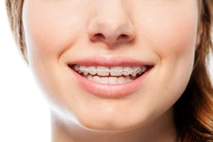 Pasang Behel Keramik di AM Dental Care