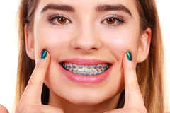 Pasang Behel Metal oleh drg. Umum di Fidental Clinic