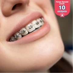 Pasang Behel Metal oleh drg. Umum di A+ Dental Care