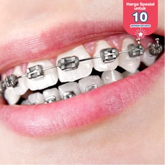 Pasang Behel Metal oleh drg. Umum di Klinik Djanti Medika