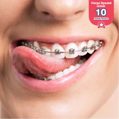 Pasang Behel Metal di D Dental Care