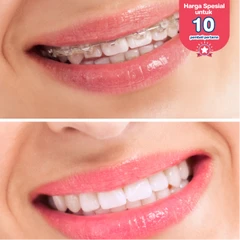 Pasang Behel Shappire oleh drg. Umum di Dental Theory