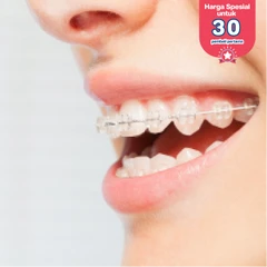 Retainer Lepasan Clear 2 Rahang di Klinik Tooth Signature