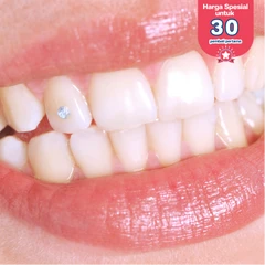 Lepas Bracket + Bleaching + Scaling dan Polishing + Fluoride Treatment di DENTALMATE DENTALCARE