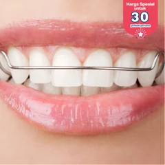 Retainer Lepasan Hawley 2 Rahang + Cetak Gigi di DENTALMATE DENTALCARE