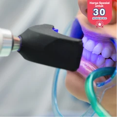 Bleaching Gigi dengan LED di Infinity Dental Studio