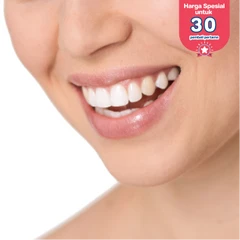 Direct Veneer Composite di Griya Denta Clinic