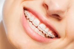 Pasang Behel Keramik oleh drg. Umum di TruSmile Dental House